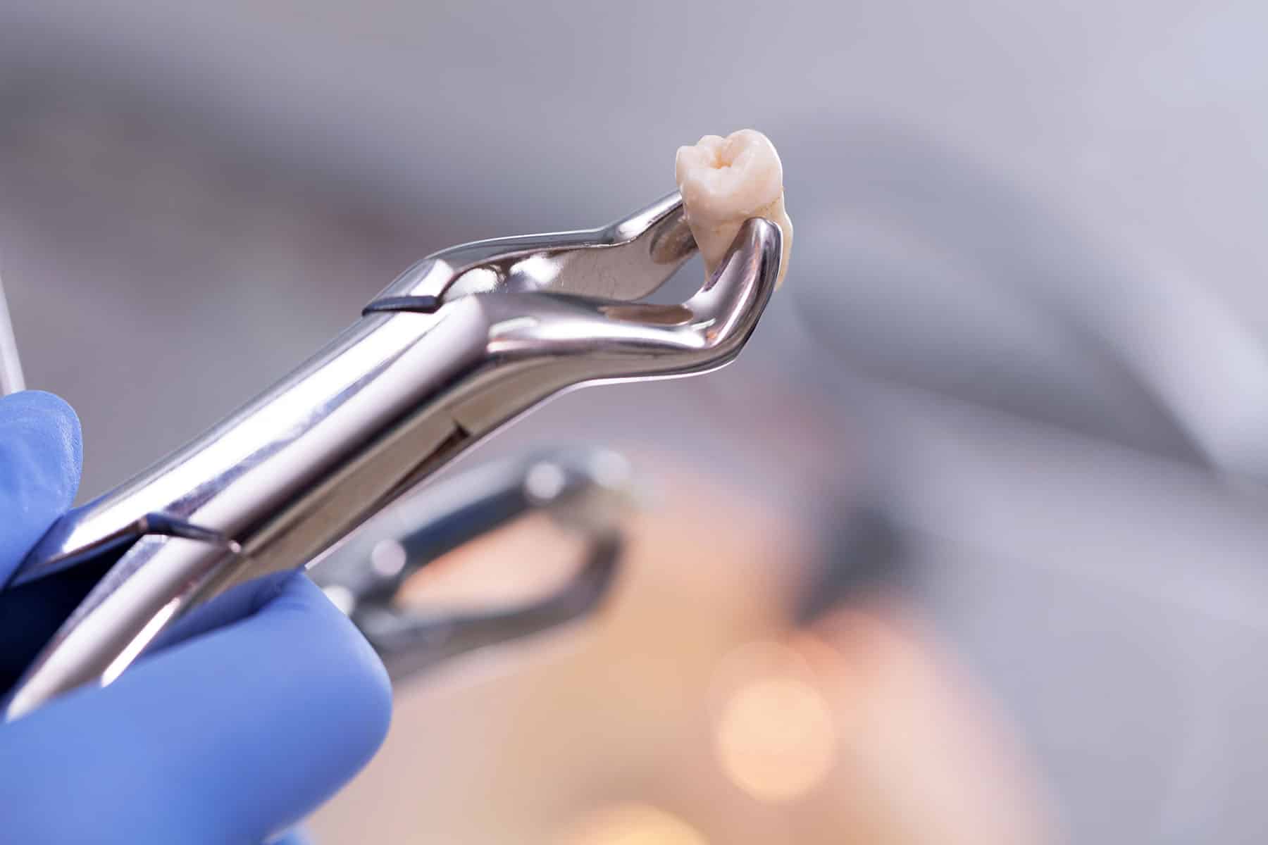 tooth extraction in winston-salem north carolina